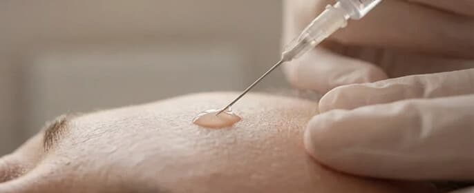 Aplikace botulotoxinu